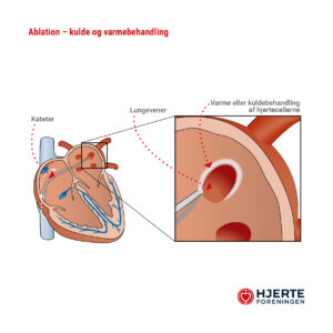 Ablation