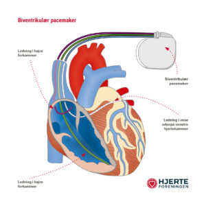 Biventrikulaer_pacemaker_illustration-002