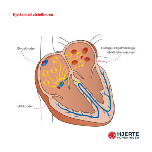 Hjerte-med-atrieflimren