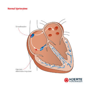 Normal-hjerterytme (1)