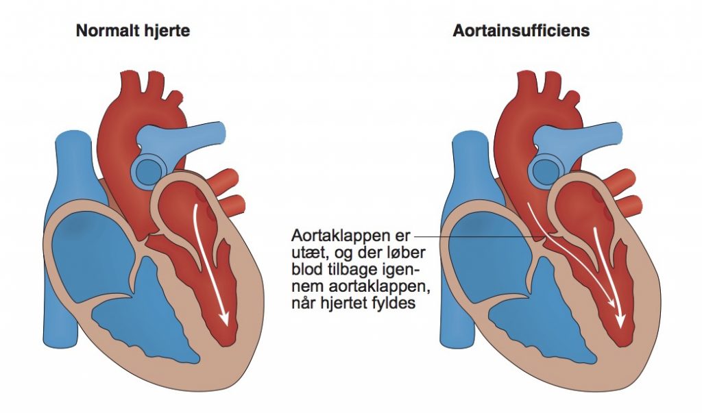 25-aortainsufficiens-figur-kopi-1