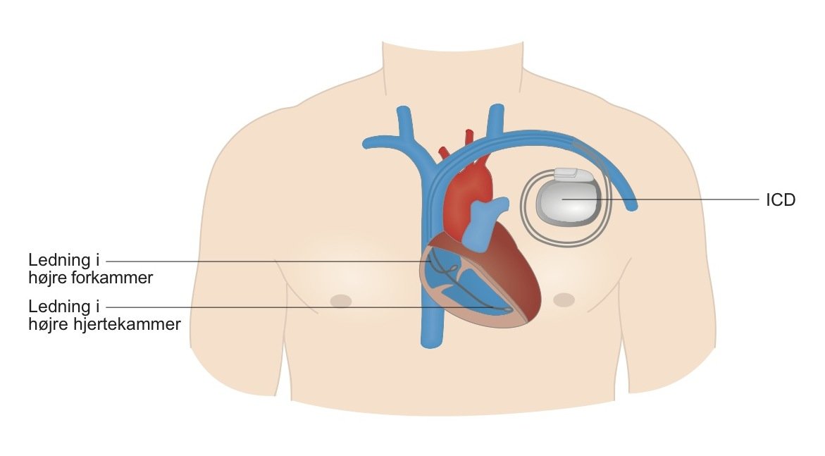 Defibrillator (ICD-enhed) | Alt du skal vide - Hjerteforeningen
