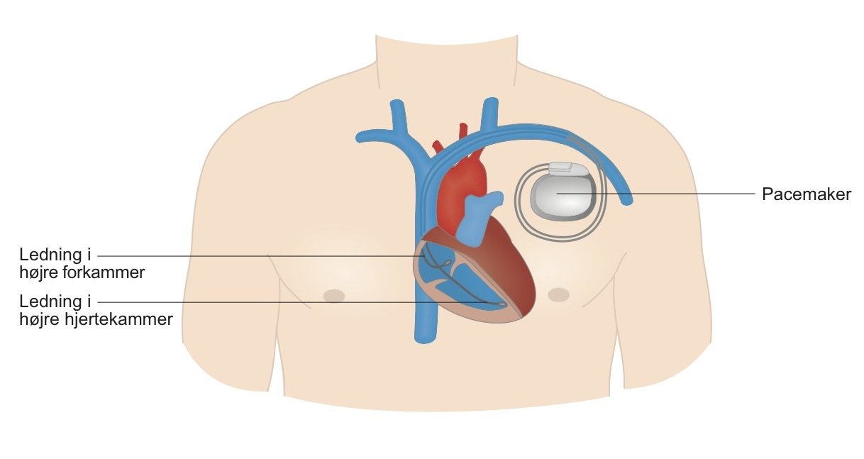 Pacemaker | Hvad det er og hvordan virker Hjerteforeningen